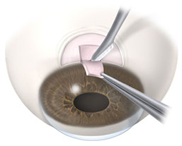 c50 trab scleral flap