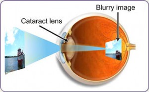 cataract eye 1